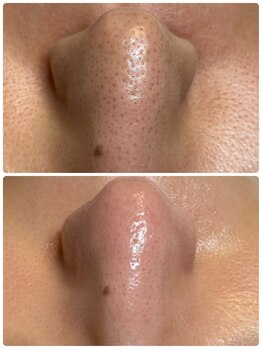 ラナ(Lana)/毛穴エクストラクション