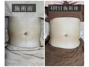 ベルフィーヌ 恵比寿店(BELFINE)/しつこいお腹の脂肪