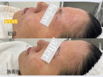 キャス(KYAS)/[ハーブピーリング]どんな肌質◎