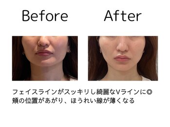 オリナ(olina)/-before & after-