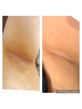 ソイ(soi)/ワキ脱毛