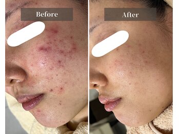 ミラリー(MIRALY)/赤み・ニキビケア 3ヶ月(20代)