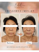 エクラヴィ(Eclatvie)/６０代★施術事例