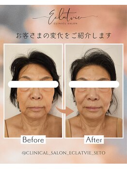 エクラヴィ(Eclatvie)/60代★施術事例