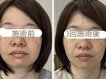 マーガレット整体/微弱電流フェイシャルの施術前後