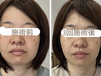 マーガレット整体/微弱電流フェイシャルの施術前後