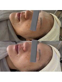 アリス(Alice)/ララピール×プラズマ