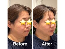 ラキネイ 目黒(Lakinei)/フェイスラインが蘇ります◎