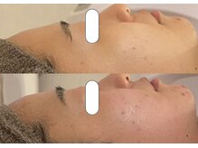 リスタ(RSTA)/【BEFORE/AFTER】