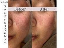 ヴィタベラ(Vita Bella)/VERUNAハーブピーリリング