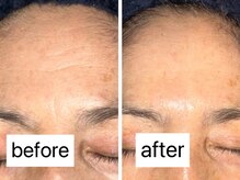 マハロ(Mahalo.N)/オーダーフェイシャル【しわ】