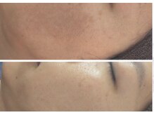 ルアーナ(Luana)/ハーブピーリング