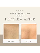 サロンアン(Salon an)/肌質改善にFCRハーブピーリング