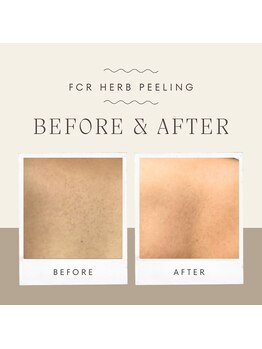 サロンアン(Salon an)/肌質改善にFCRハーブピーリング