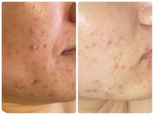 ラナ(Lana)/肌質改良ならハーブピーリング！