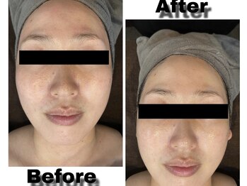 レイズ(RAISE)/目指せ韓流肌！透明水光ピール