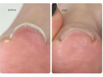 ロンディネ(Rondine)/巻き爪ケア/ネイルトリム10