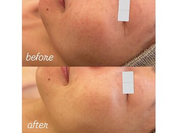 リノ(Lino)/陶肌トリートメントbefore after