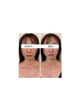 スリーメイ(3mey)/【小顔・たるみ改善】