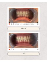 スマイルプライベートビューティサロン(Smile)/セルフホワイトニング（初回）