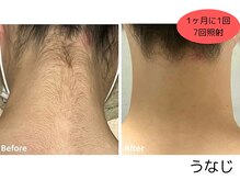 【脱毛・よもぎ蒸しサロン】Quokka/うなじ脱毛