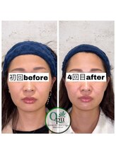 キュープ 相模原淵野辺店(Qpu)/たった4回で人生で1番小さな顔に