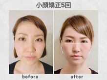 ビトリア 横浜店(BITORIA)の雰囲気(頬出っ張り、ほうれい線、エラ張り、フェイスラインなど改善)