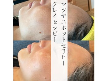 エネ(eNe)/１回の施術でも効果はしっかり！