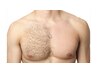 【men's】胸毛＆へそ周り脱毛