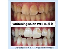ホワイトニングサロン ホワイト(WHITE)/セルフホワイトニング/大阪/福島