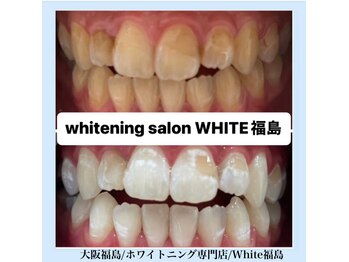 ホワイトニングサロン ホワイト(WHITE)/セルフホワイトニング/大阪/福島