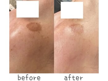 トモズサロン28(Tomos.salon.)/シミ改善！くすみ改善に◎