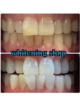 ホワイトニングショップ 京都駅前店/40分×10回Before/After