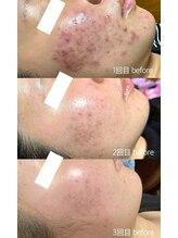 アンノン(Annon)/臍帯羊膜幹細胞×エラスチン症例