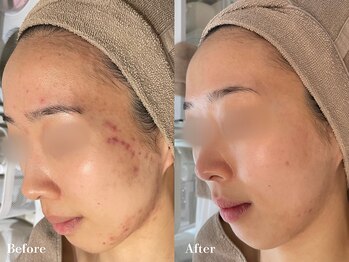 シーヴォーク(Cveauque)の写真/【肌トラブル改善/完全オーダーメイド施術】結果重視！二人三脚で寄り添った本気の改善ケア◎
