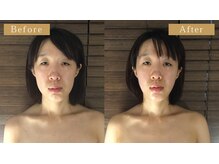 モモスパ(MOMOspa.)/頭蓋骨小顔矯正ビフォアフター