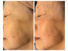 ソルツーサロン マナ(MANA)/深層筋にアプローチでハリUP