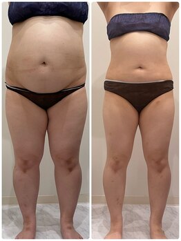 ヴォアール 東静岡店(VOIR)/痩身2ヶ月通い放題