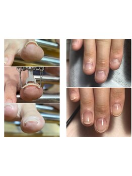 爪の悩みを解消できる（ケア含む）
