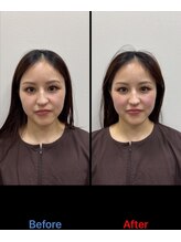 ラムーン(La.Moon)/小顔・美容鍼1回