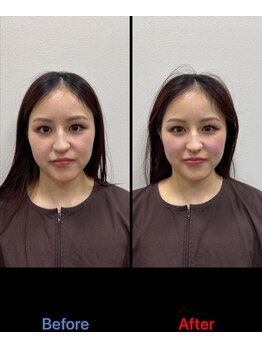 ラムーン(La.Moon)/小顔・美容鍼1回