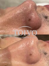 トイヴォ(TOIVO)/毛穴洗浄ビフォーアフター！