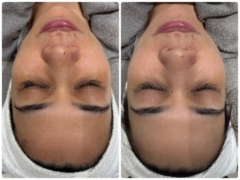 ウェイビーズ エステ(wavy's.esthetic)/【ビフォーアフター】くすみ改善