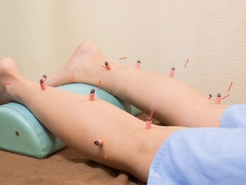 いなほ はりきゅう整骨院 東新宿/鍼灸(吸い玉併用)コース