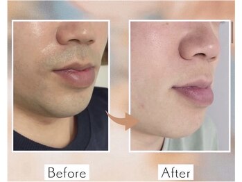 アカヌケ(AKANUKE)/ヒゲ脱毛