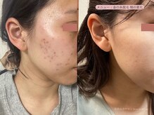 レスイズモア 恵比寿(less is more.)/金の糸脱の変化