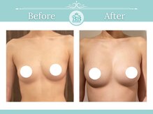 美人バスト 浜松店/◇ バストアップ &nbsp;BeforeAfter◇