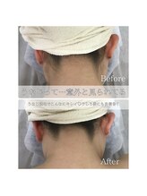 TD 清洲店/うなじ脱毛