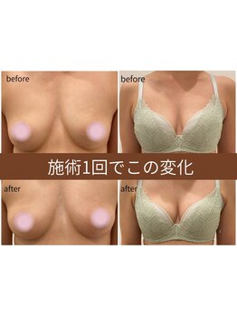 バストラインを整えたい