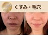 【たるみ、くすみ、毛穴の開きに】たるみ改善×プラセンタケア×ララピール